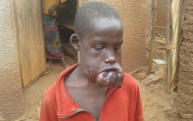 Rwanda Government to Treat Teenage Boy With Rare Disease